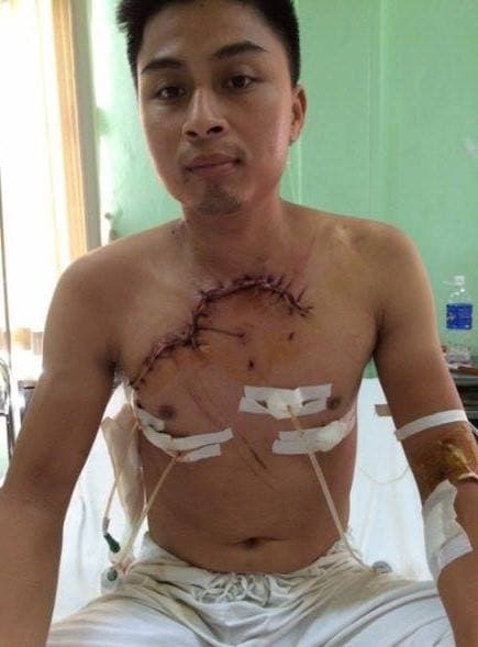 Bệnh viện Việt Đức cứu sống bệnh nhân bị tai nạn giao thông tim, phổi lộ ra ngoài